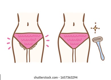 Illustration of pubic hair treatment