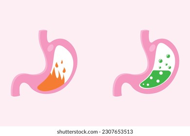 ilustración de la pirosis estomacal y náuseas estomacales. Trastorno por incendio por pirosis, reflujo de ácido gástrico. Conjunto de ilustraciones médicas Stomach