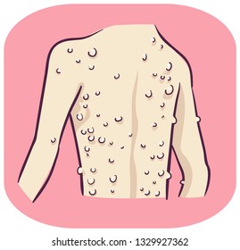 Illustration of Raised Bumps on Skin Mostly at the Back. Neurofibromatosis