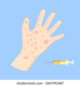 Illustration of a red dot on the hand. Of chicken pox