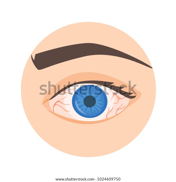 Illustration Red Eye Disease Infection Stock Vector (Royalty Free