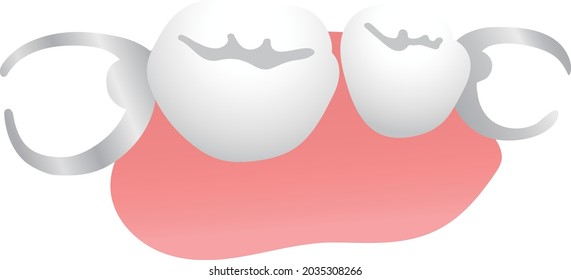 Illustration of removable partial denture.