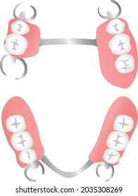 Illustration of removable partial denture (occlusal surface)