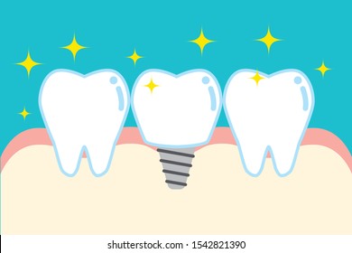 Illustration of removal of tooth
