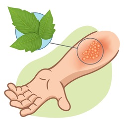 Illustration Representing First Aid Arm With Allergy And Allergic Rashes Due To Poison Ivy Poisoning 