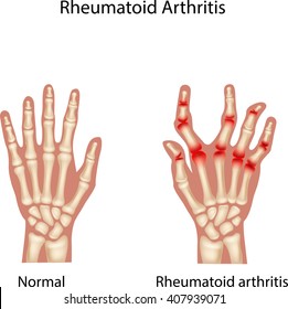 Illustration of Rheumatoid Arthi