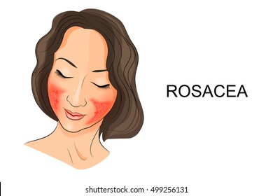 illustration of rosacea on the girl's face. Dermatology
