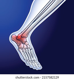 Ilustración de un hueso de tobillo en marcha que muestra puntos rojos que representan una lesión articular. uso médico educativo y científico