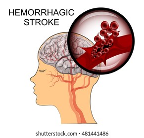 illustration of a rupture of the vessel. hemorrhagic stroke. insult. red blood cells. 