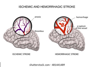 Illustration Rupture Vessel Hemorrhagic Stroke Insult Stock Vector ...