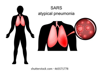 illustration of SARS. inflamed lungs and the causative agent. virus
