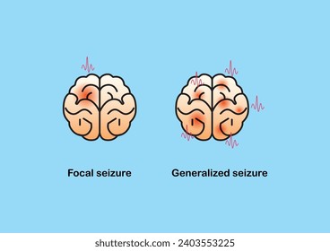 Illustration of seizure types demonstrating by onset and brain waves. Vector illustration. 