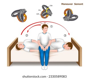 illustration of the Semont maneuver, a practical guide to the treatment of positional paroxysmal vertigo. Teaching aid. Vector.