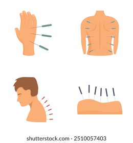 Illustration set of acupuncture therapy, a holistic. Natural. And ancient chinese medicine technique for pain relief. Relaxation. And rejuvenation. Using noninvasive. Therapeutic