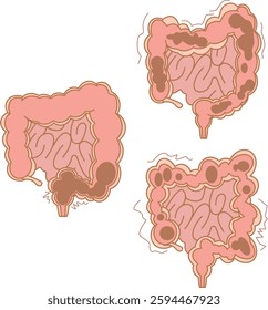 Illustration set of atonic constipation, spasmodic constipation and rectal constipation