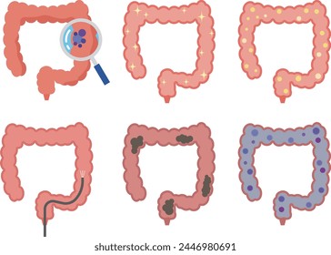 Illustration set of colon conditions