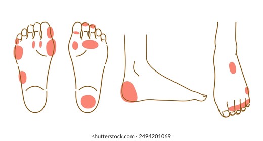 Illustration set of corns and calluses on the soles and insteps of the feet (women's feet)