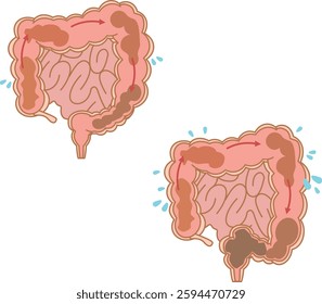 Illustration set of the large intestine where excretion is performed smoothly and the large intestine where lack of water causes constipation