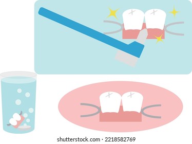 Illustration set of partial dentures