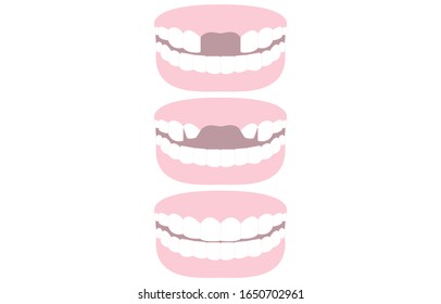 Illustration set of teeth bridging the missing front teeth