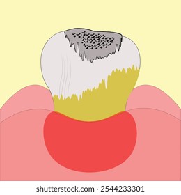 Illustration of severe tooth decay and gum infection highlighting dental health issues. Ideal for educational content, dental clinics, medical health awareness materials. detailed, and informative