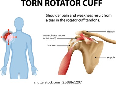 Illustration of shoulder anatomy and injury details