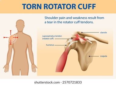 Illustration of shoulder anatomy and injury details