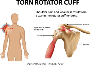 Illustration of shoulder anatomy and injury details