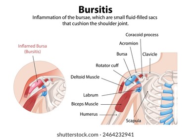 Illustration of shoulder bursitis and anatomy