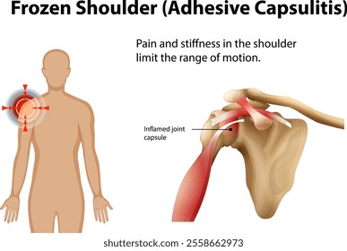 Illustration of shoulder pain and inflammation