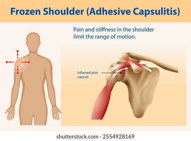 Illustration of shoulder pain and inflammation causes
