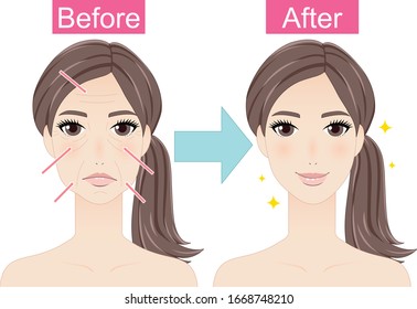 Illustration show before and after of adult woman's make botox filler at beauty clinic.