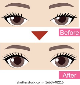 Illustration show before and after of woman's double eyelid surgery.