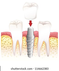 Illustration showing dental crown procedure