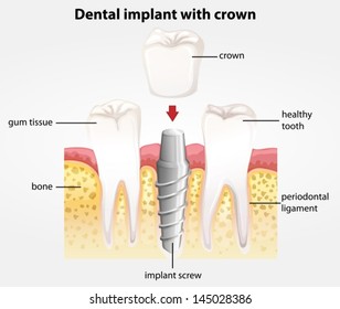 Illustration Showing The Dental Implant With Crown