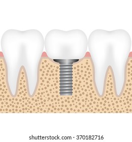 Illustration showing the dental implant with crown