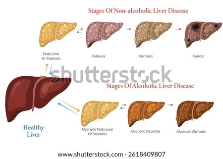 An illustration showing diagrams comparing non alcoholic and alcoholic liver disease stages with liver damage progression in each condition