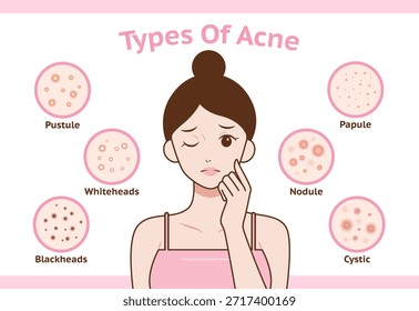 Ilustración que muestra diferentes tipos de acné en una cara femenina: puntos negros, puntos blancos, pápulas, pústulas, nódulos y acné quístico. Cuidado de la piel y dermatología infografía educativa