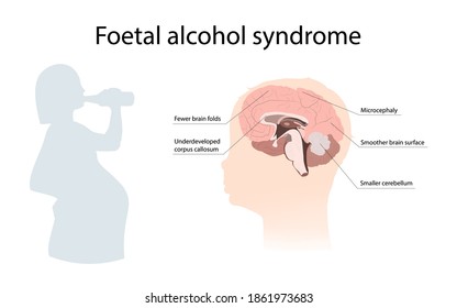 Illustration showing the effects of foetal alcohol syndrome on the brain. With explanations. Drinking pregnant woman.