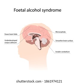 Illustration showing the effects of foetal alcohol syndrome on the brain. With explanations.