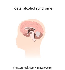 Illustration showing the effects of foetal alcohol syndrome on the brain.