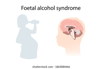 Illustration showing the effects of foetal alcohol syndrome on the brain. Drinking pregnant woman.