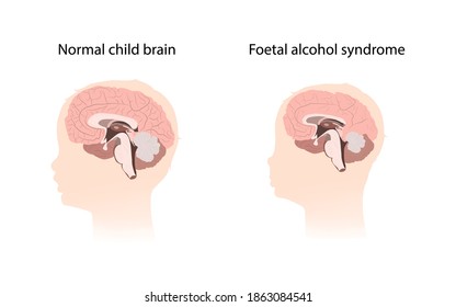 Illustration showing the effects of foetal alcohol syndrome on the brain. Comparison with normal healthy