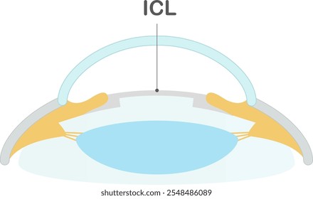 Illustration showing an eye after corrective vision surgery