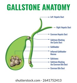 An illustration showing gallstone anatomy depicts the gallbladder bile ducts and stones highlighting their size shape and location within the biliary system for educational understanding