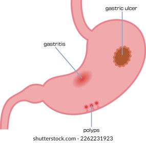 Illustration showing gastritis, stomach ulcer and polyp