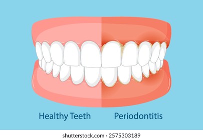 Illustration showing healthy teeth versus periodontitis effects