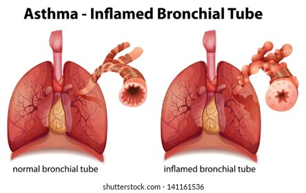 Illustration showing the inflamation of the bronchus causing asthma