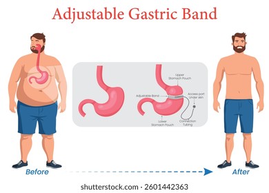 An illustration showing a man before and after adjustable gastric band surgery, highlighting weight loss and body shape changes.