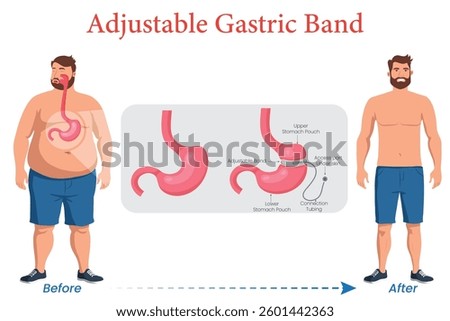 An illustration showing a man before and after adjustable gastric band surgery, highlighting weight loss and body shape changes.